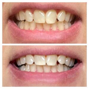 teeth whitening progress