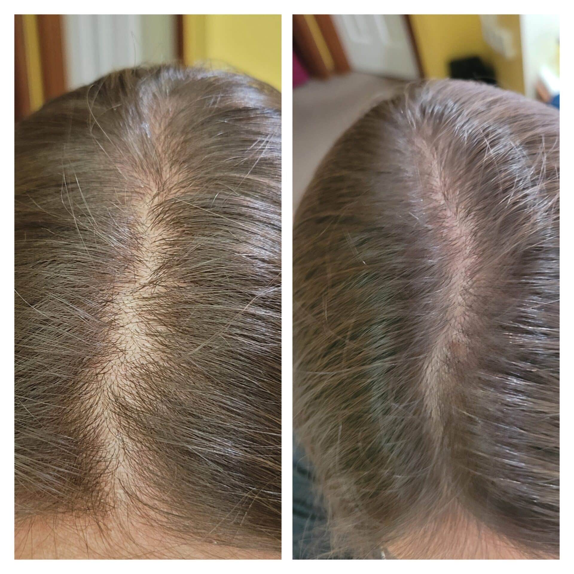 Before and after photo of hair growing back after using Glow liquid collagen
