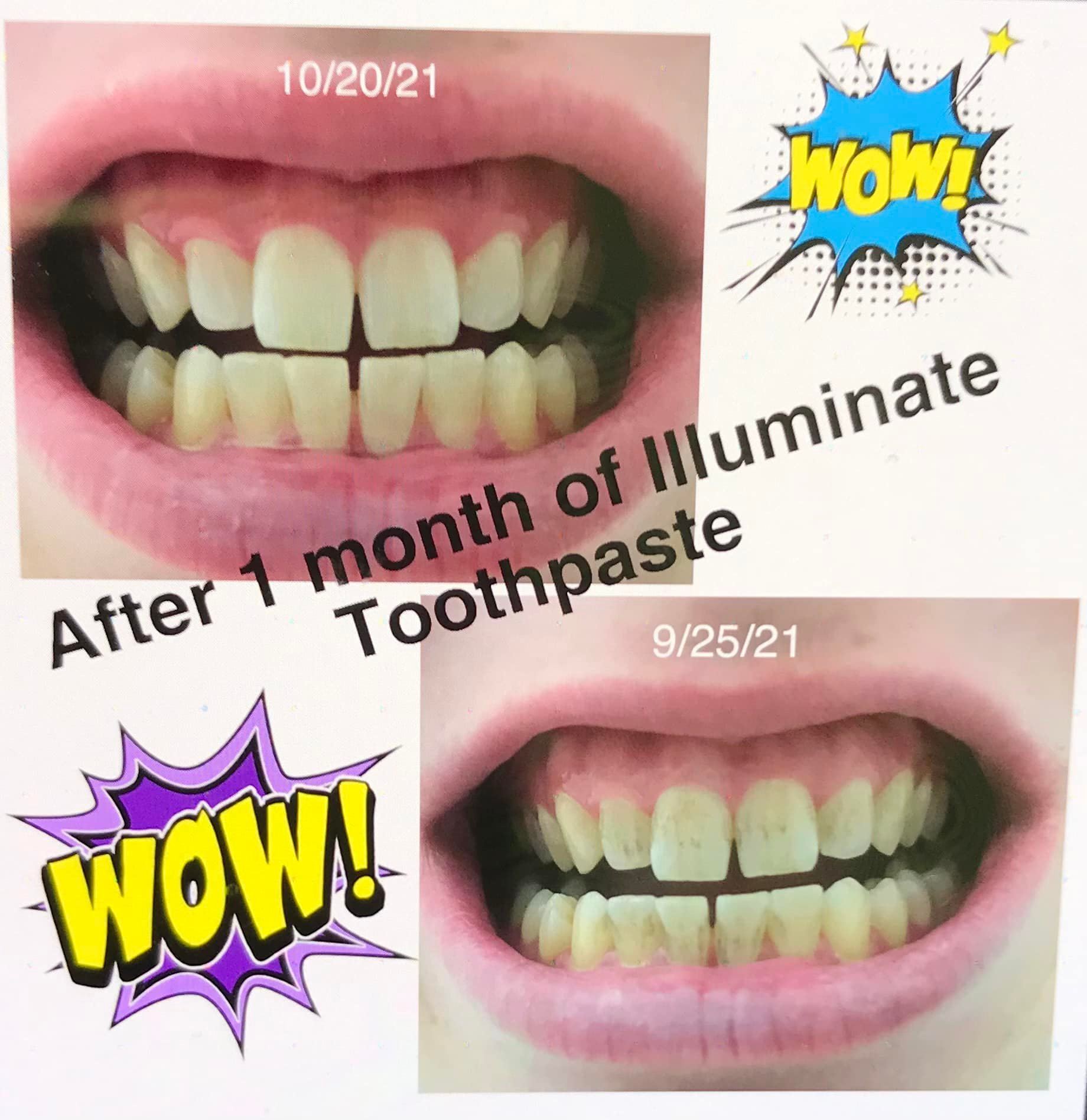 teeth whitening progress