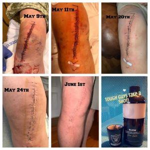 Before and after scars from a knee surgery after using Glow liquid collagen