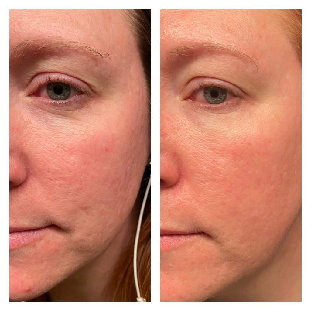 Before and after results from using Glow liquid collagen
