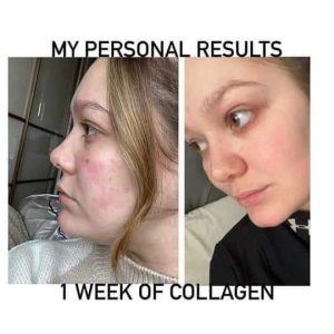 Before and after results from using Glow liquid collagen