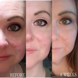 Before and after results from using Glow liquid collagen