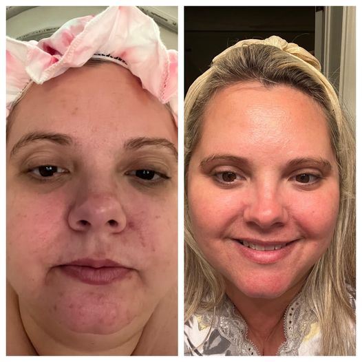 Before and after results from using Glow liquid collagen