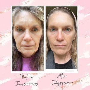 Before and after results from using Glow liquid collagen