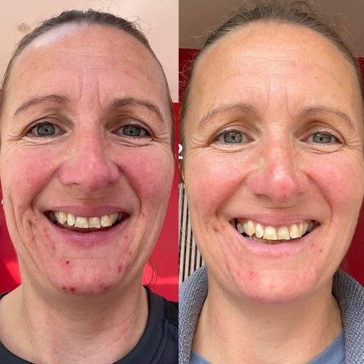 Before and after results from using Glow liquid collagen
