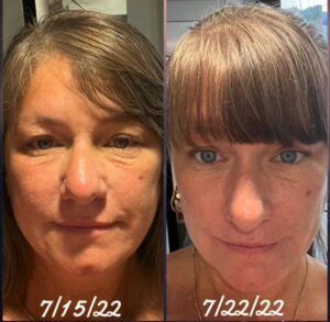 Before and after results from using Glow liquid collagen