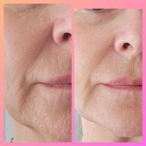 Before and after results from using Glow liquid collagen