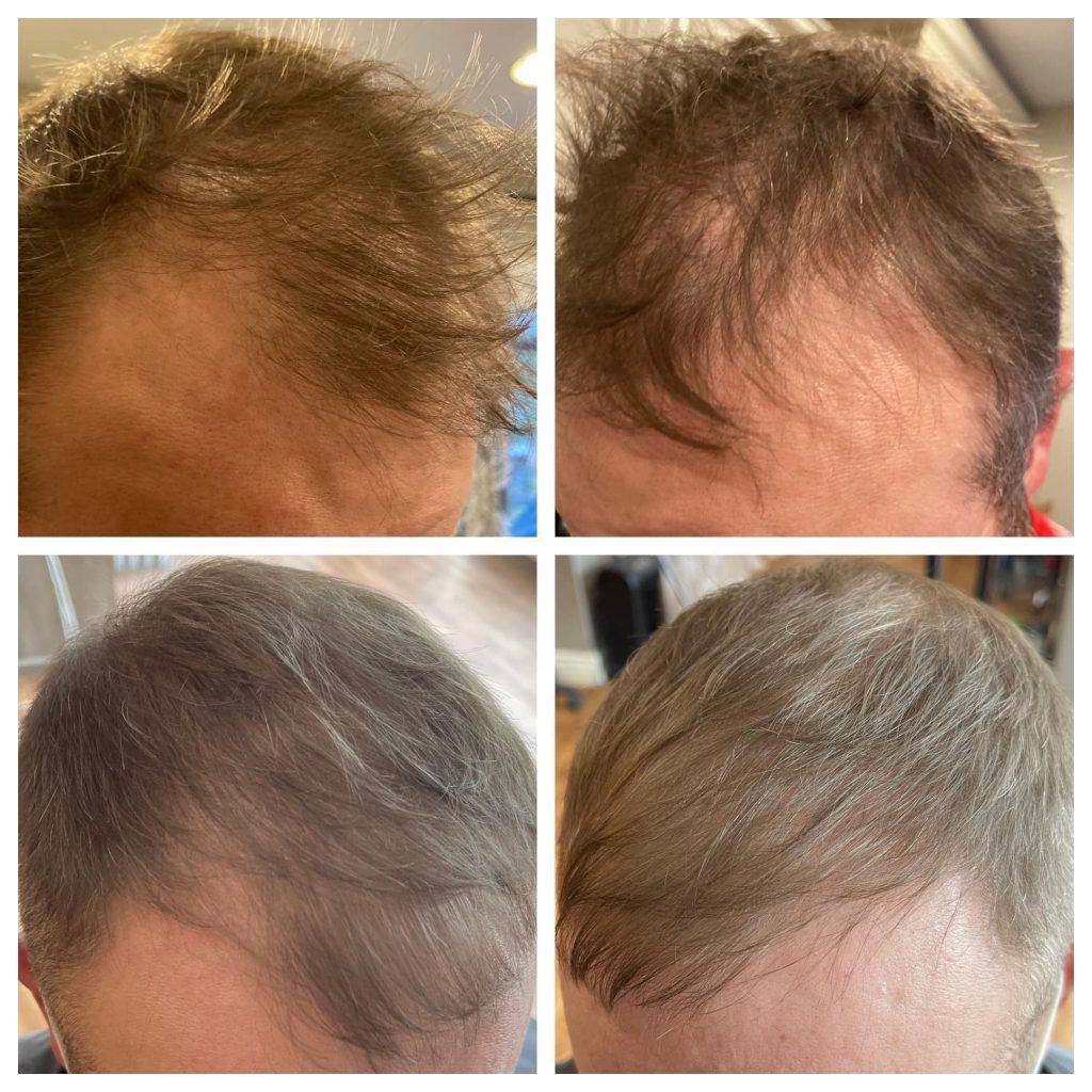 Before and after photo of hair growing back after using Glow liquid collagen