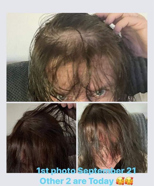 Before and after photo of hair growing back after using Glow liquid collagen