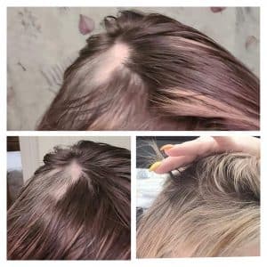 Before and after photo of hair growing back after using Glow liquid collagen