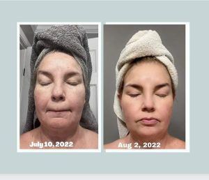 Before and after results from using Glow liquid collagen