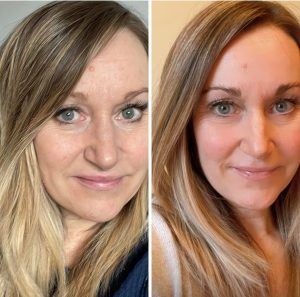 Before and after results from using Glow liquid collagen