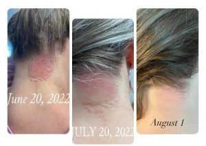 Before and after photos of psoriasis disappearing after using Glow liquid collagen and Enrich digestive enzymes