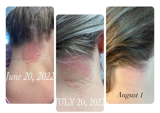 Before and after photos of psoriasis disappearing after using Glow liquid collagen and Enrich digestive enzymes