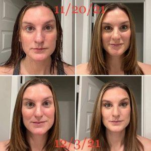 Before and after results from using Glow liquid collagen