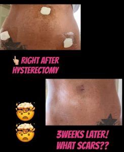 before and after photo of hysterectomy scars after using Glow liquid collagen