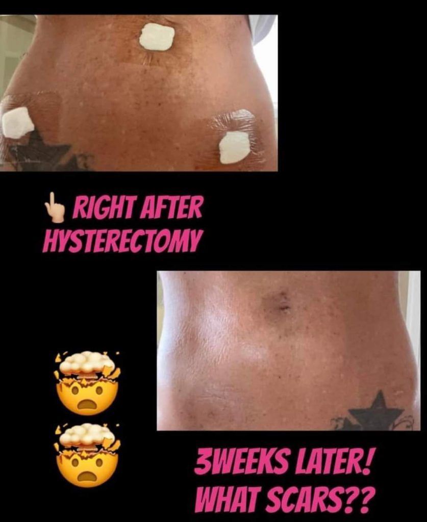 before and after photo of hysterectomy scars after using Glow liquid collagen