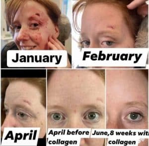 Before and after photos showing how quickly her scars have disappeared after using Glow liquid collagen for 8 weeks