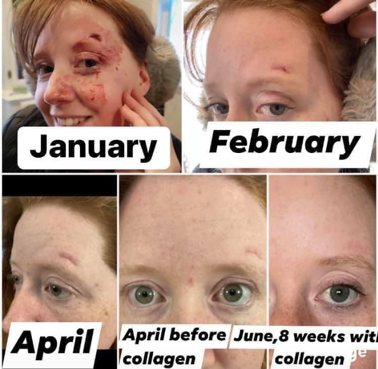 Before and after photos showing how quickly her scars have disappeared after using Glow liquid collagen for 8 weeks