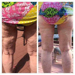 Before and after results of cellulite disappearing after using Glow liquid collagen