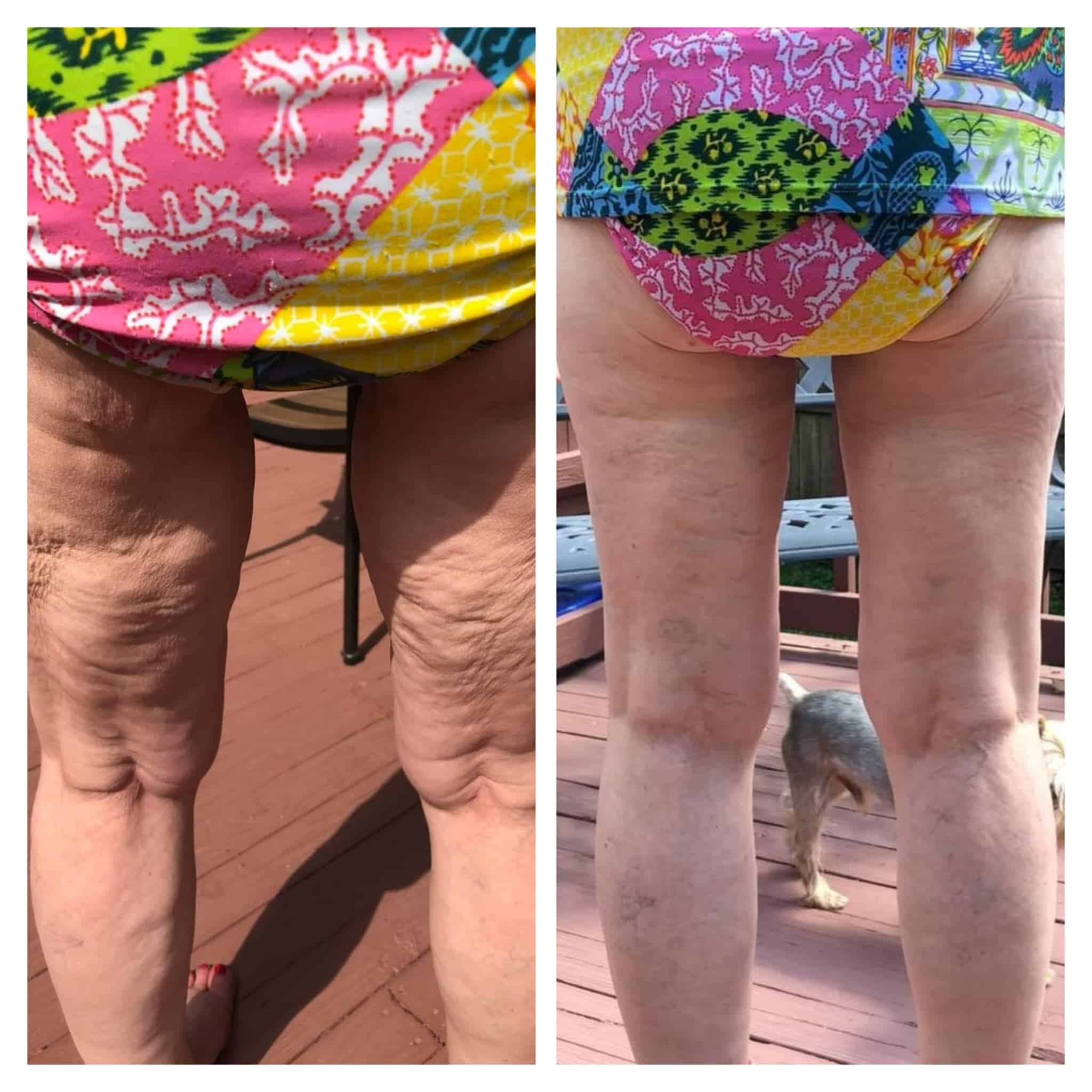 Before and after results of cellulite disappearing after using Glow liquid collagen