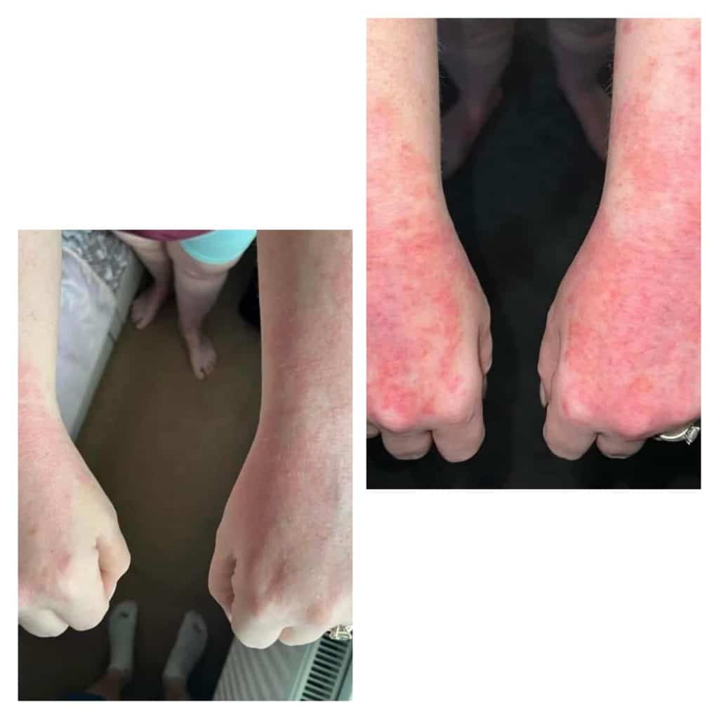 Before and after photo showing results of using Enrich digestive enzymes. The psoriasis on her hands and arms have cleared up.