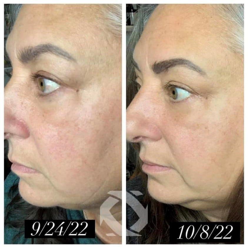 Before & after photo of personal results from using Rejuvenate hydrating serum