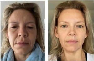 Drastic before & after photo of personal results from using Glow Liquid Collagen