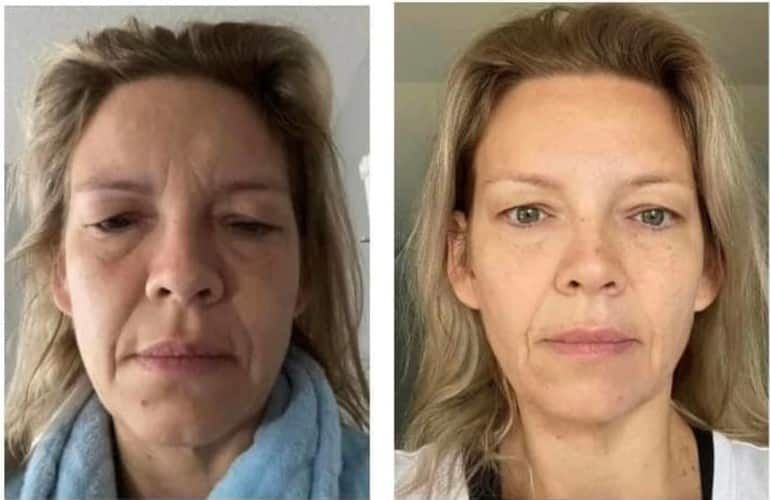 Drastic before & after photo of personal results from using Glow Liquid Collagen