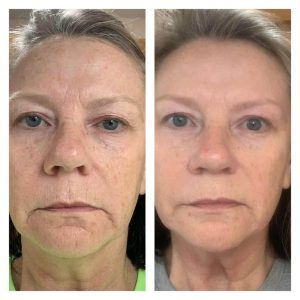 Before & after photo with personal results from using Rejuvenate hydrating serum