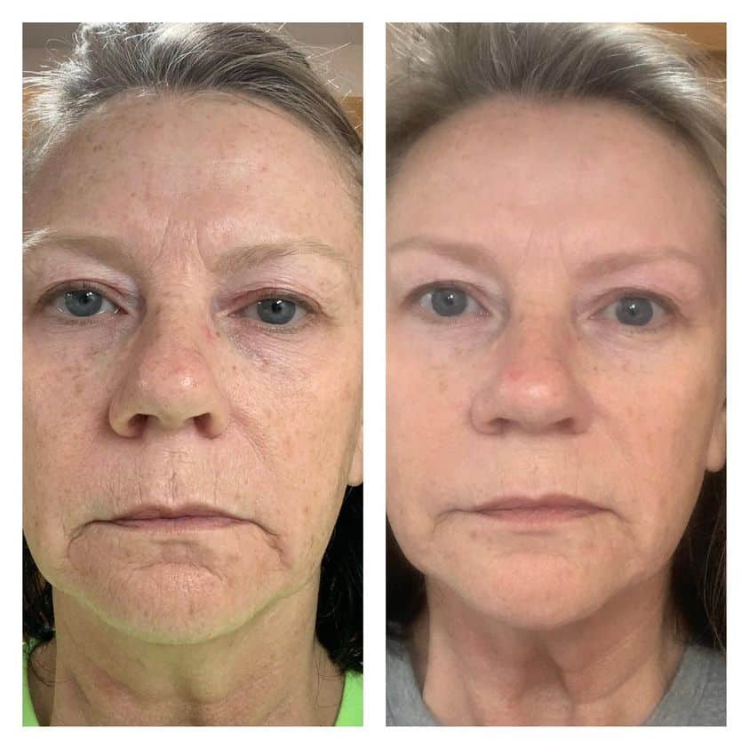 Before & after photo with personal results from using Rejuvenate hydrating serum
