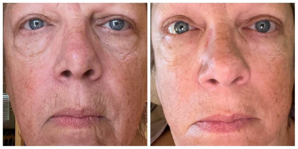 Before & After photo with personal results of using Glow Liquid Collagen