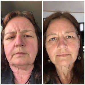 Before & after results of using Glow liquid collagen & Enrich digestive enzymes