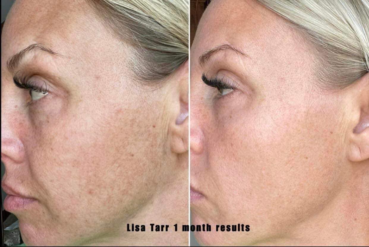 1 month before & after photo of personal results from using Rejuvenate hydrating serum