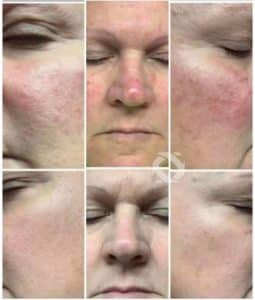 Before & after photo of personal results from using Glow Liquid Collagen