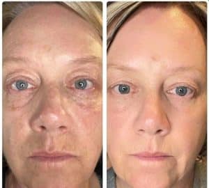 Before & After results of using Glow Liquid Collagen & Rejuvenate hydrating serum