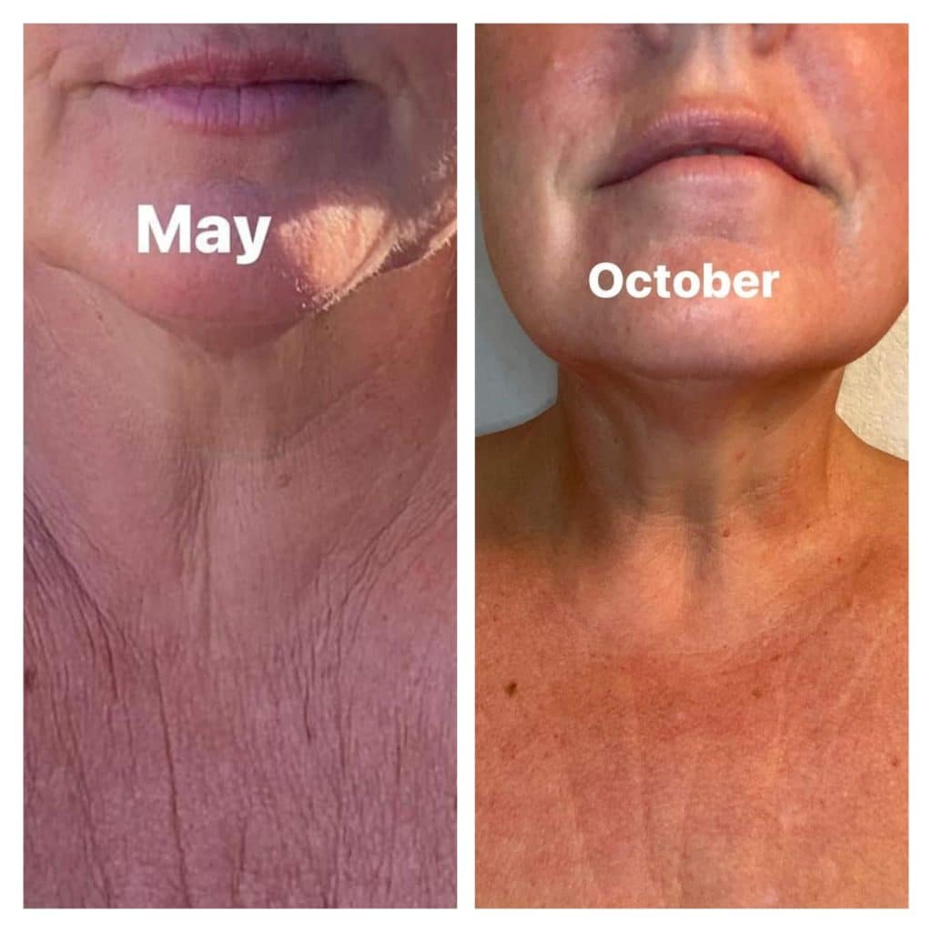 Before and after results from taking Glow liquid collagen