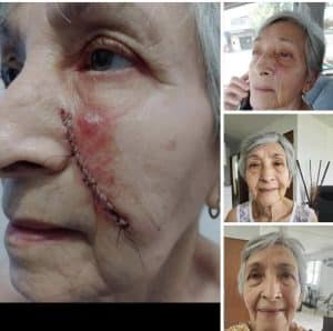 Before and after scar after using Glow