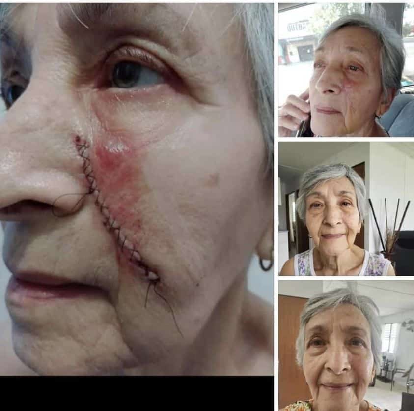 Before and after scar after using Glow