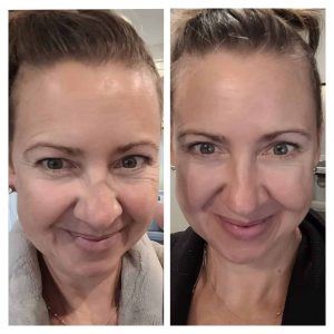 Before and after results from taking Glow liquid collagen