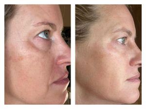 Results from using Glow and rejuvenate