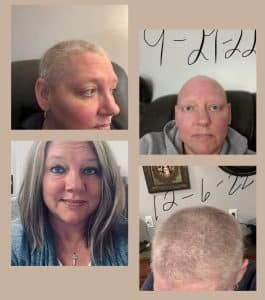 Before and after Cancer photo of hair growth due to Glow