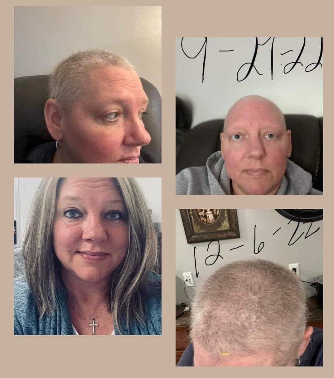 Before and after Cancer photo of hair growth due to Glow