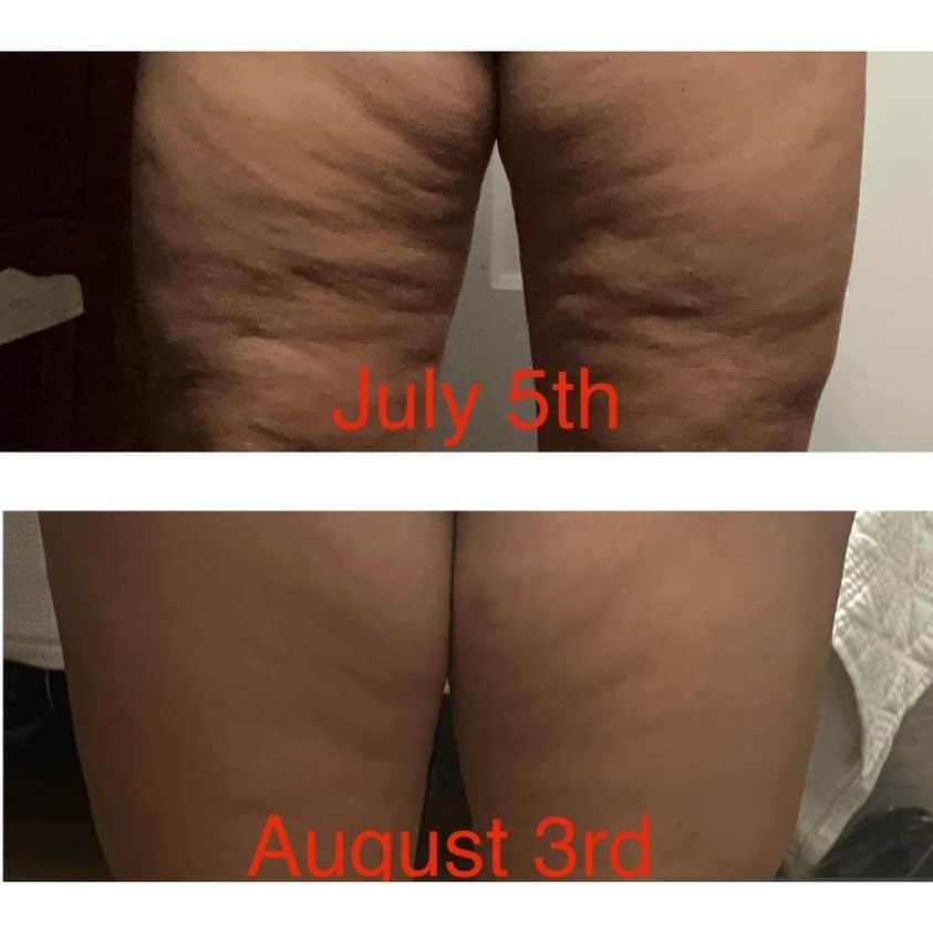Before and after of thighs from taking Glow