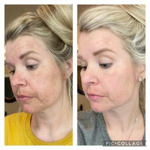 Before and after results from Glow and Rejuvenate.