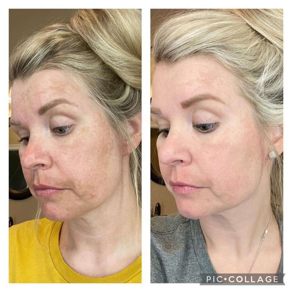 Before and after results from Glow and Rejuvenate.