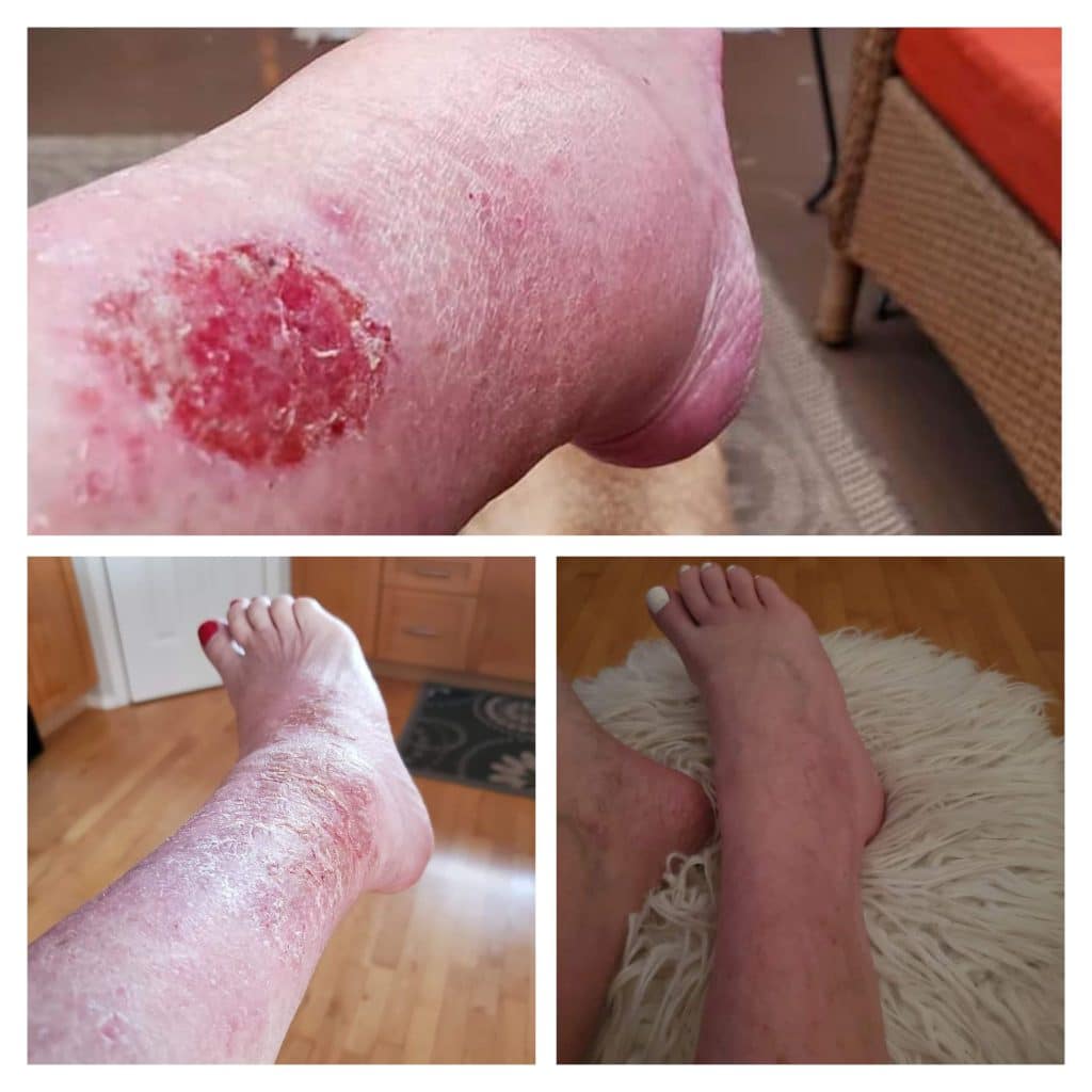 Rash before and after photos after using Glow