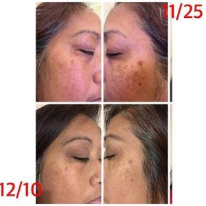 Before and after photos of a face after using Rejuvenate hydrating serum for 30 days
