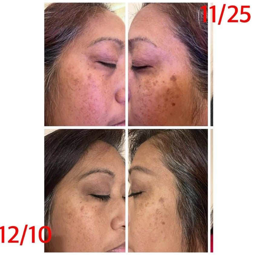 Before and after photos of a face after using Rejuvenate hydrating serum for 30 days